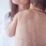 Measles Outbreaks on the Rise