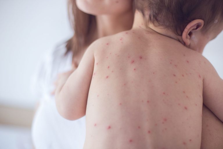 Measles Outbreaks on the Rise